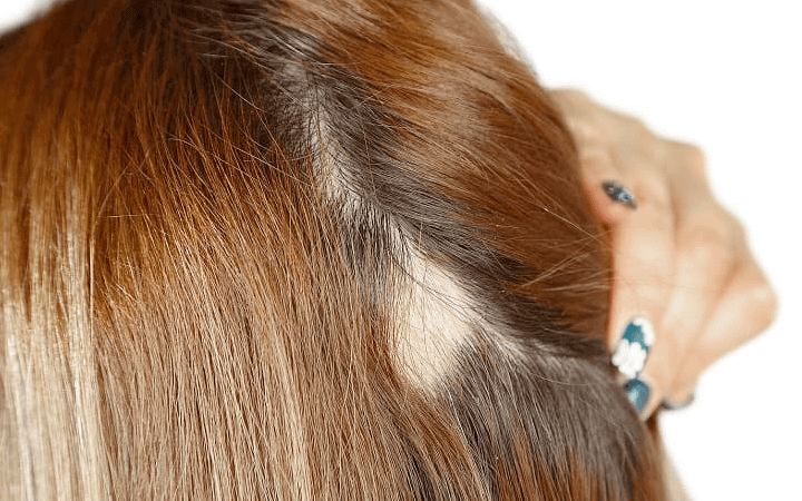 Kreisrunder Haarausfall bei Frauen